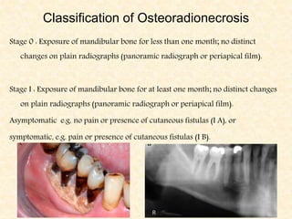 Classification of Osteoradionecrosis
Stage 0 : Exposure of mandibular bone for less than one month; no distinct
changes on plain radiographs (panoramic radiograph or periapical film).
Stage I : Exposure of mandibular bone for at least one month; no distinct changes
on plain radiographs (panoramic radiograph or periapical film).
Asymptomatic e.g. no pain or presence of cutaneous fistulas (I A), or
symptomatic, e.g. pain or presence of cutaneous fistulas (I B).
 