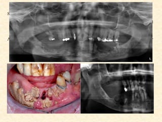 Stage II : Exposure of mandibular bone for at least one month; distinct changes
present on plain radiographs (panoramic radiograph or periapical film), but
not involving the lower border of the mandible.
Asymptomatic otherwise, e.g. no pain or presence of cutaneous fistulas (II A), or
Symptomatic, e.g. pain or presence of cutaneous fistulas (II B).
Stage III : Exposure of mandibular bone for at least one month; distinct changes
on plain radiographs (panoramic radiograph or periapical film), involving
the lower border of the mandible, irrespective of any other signs and
symptoms. Note: In case of doubt about the presence and/or extent of
radiographical bone involvement, the lower stage should be allotted.
 