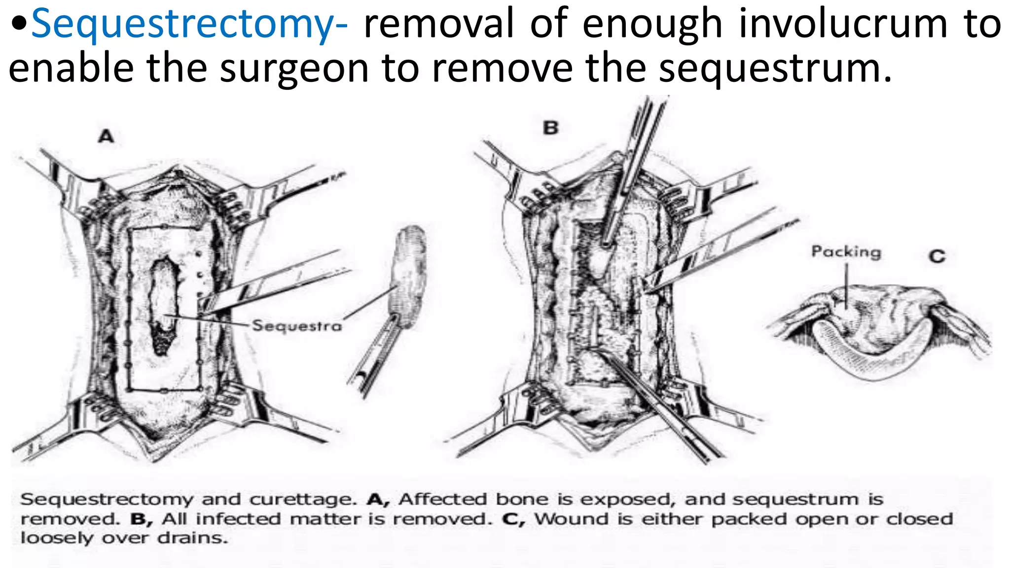 Osteomyelitis and its management | PPTX