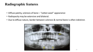 Osteomyelitis of facial skeleton | PPTX