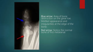Blue arrow: Area of bone
destruction on the great toe.
Mottled appearance and
irregularities at the edge of the
bone.
Red arrow: Notice the normal
bone of first metatarsal
 