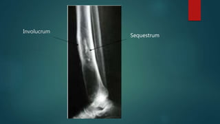 Involucrum
Sequestrum
 