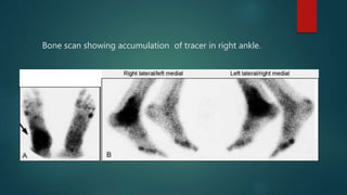 Bone scan showing accumulation of tracer in right ankle.
 
