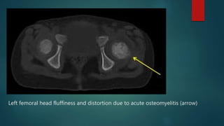 Left femoral head fluffiness and distortion due to acute osteomyelitis (arrow)
 