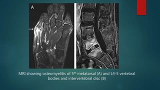 MRI showing osteomyelitis of 5th metatarsal (A) and L4-5 vertebral
bodies and intervertebral disc (B)
 