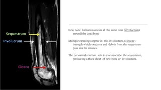 New bone formation occurs at the same time (involucrum)
around the dead bone
Multiple openings appear in this involucrum, (cloacae)
through which exudates and debris from the sequestrum
pass via the sinuses.
The periosteal reaction acts to circumscribe the sequestrum,
producing a thick sheet of new bone or involucrum.
 