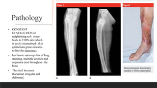 Pathology
• CONSTANT
DESTRUCTION of
neighboring soft tissue
leads to THIN skin which
is easily traumatised , skin
epithelium grows inwards
to line the sinus tract.
• In chronic osteomyelitis of long
standing, multiple cavities and
sequestra exist throughout the
bone
• The shaft becomes
thickened, irregular and
deformed.
 