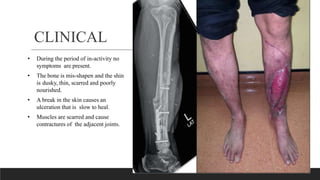 CLINICAL
• During the period of in-activity no
symptoms are present.
• The bone is mis-shapen and the shin
is dusky, thin, scarred and poorly
nourished.
• A break in the skin causes an
ulceration that is slow to heal.
• Muscles are scarred and cause
contractures of the adjacent joints.
 