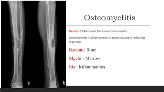 Osteomyelitis
Nelaton 1834 coined the term Osteomyelitis
Osteomyelitis is inflammation of bone caused by infecting
organism.
Osteon : Bone
Myelo : Marrow
Itis : Inflammation
 