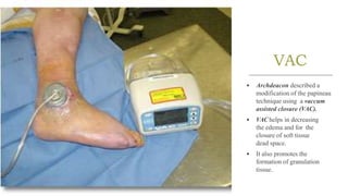 VAC
• Archdeacon described a
modification of the papineau
technique using a vaccum
assisted closure (VAC).
• VAC helps in decreasing
the edema and for the
closure of soft tissue
dead space.
• It also promotes the
formation of granulation
tissue.
 