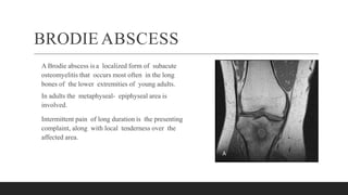 BRODIE ABSCESS
A Brodie abscess is a localized form of subacute
osteomyelitis that occurs most often in the long
bones of the lower extremities of young adults.
In adults the metaphyseal- epiphyseal area is
involved.
Intermittent pain of long duration is the presenting
complaint, along with local tenderness over the
affected area.
 