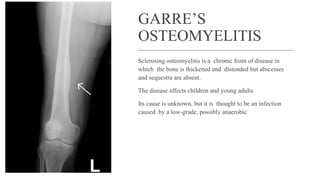 GARRE’S
OSTEOMYELITIS
Sclerosing osteomyelitis is a chronic from of disease in
which the bone is thickened and distended but abscesses
and sequestra are absent.
The disease affects children and young adults
Its cause is unknown, but it is thought to be an infection
caused by a low-grade, possibly anaerobic
 