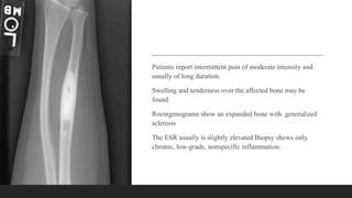 Patients report intermittent pain of moderate intensity and
usually of long duration.
Swelling and tenderness over the affected bone may be
found
Roentgenograms show an expanded bone with generalized
sclerosis
The ESR usually is slightly elevated Biopsy shows only
chronic, low-grade, nonspecific inflammation.
 