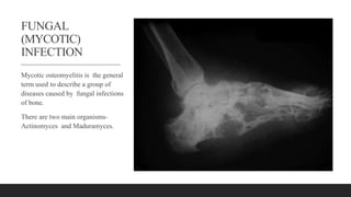 FUNGAL
(MYCOTIC)
INFECTION
Mycotic osteomyelitis is the general
term used to describe a group of
diseases caused by fungal infections
of bone.
There are two main organisms-
Actinomyces and Maduramyces.
 