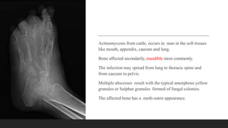 Actinomycosis from cattle, occurs in man in the soft tissues
like mouth, appendix, caecum and lung.
Bone affected secondarily, mandible most commonly.
The infection may spread from lung to thoracic spine and
from caecum to pelvis.
Multiple abscesses result with the typical amorphous yellow
granules or Sulphur granules formed of fungal colonies.
The affected bone has a moth-eaten appearance.
 