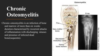 Chronic
Osteomyelitis
Chronic osteomyelitis is an infection of bone
and marrow of more than six weeks
duration characterised by recurrent attacks
of inflammation with discharging sinuses
and presence of infected dead
bone(sequestra).
 