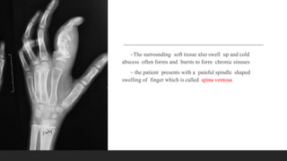 ~The surrounding soft tissue also swell up and cold
abscess often forms and bursts to form chronic sinuses
~ the patient presents with a painful spindle shaped
swelling of finger which is called spina ventosa
 