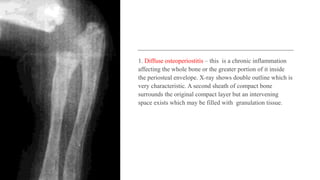 1. Diffuse osteoperiostitis – this is a chronic inflammation
affecting the whole bone or the greater portion of it inside
the periosteal envelope. X-ray shows double outline which is
very characteristic. A second sheath of compact bone
surrounds the original compact layer but an intervening
space exists which may be filled with granulation tissue.
 