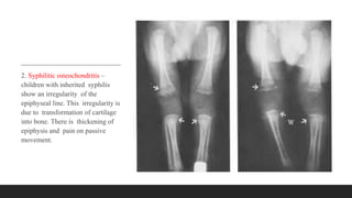 2. Syphilitic osteochondritis –
children with inherited syphilis
show an irregularity of the
epiphyseal line. This irregularity is
due to transformation of cartilage
into bone. There is thickening of
epiphysis and pain on passive
movement.
 