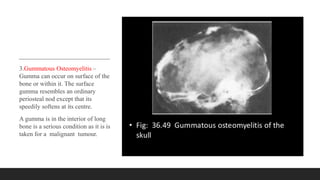 3.Gummatous Osteomyelitis –
Gumma can occur on surface of the
bone or within it. The surface
gumma resembles an ordinary
periosteal nod except that its
speedily softens at its centre.
A gumma is in the interior of long
bone is a serious condition as it is is
taken for a malignant tumour.
 