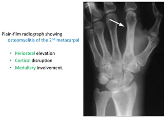 Plain-film radiograph showing
osteomyelitis of the 2nd metacarpal
• Periosteal elevation
• Cortical disruption
• Medullary involvement.
 