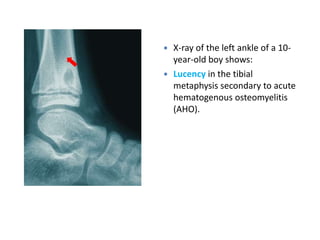  X-ray of the left ankle of a 10-
year-old boy shows:
 Lucency in the tibial
metaphysis secondary to acute
hematogenous osteomyelitis
(AHO).
 