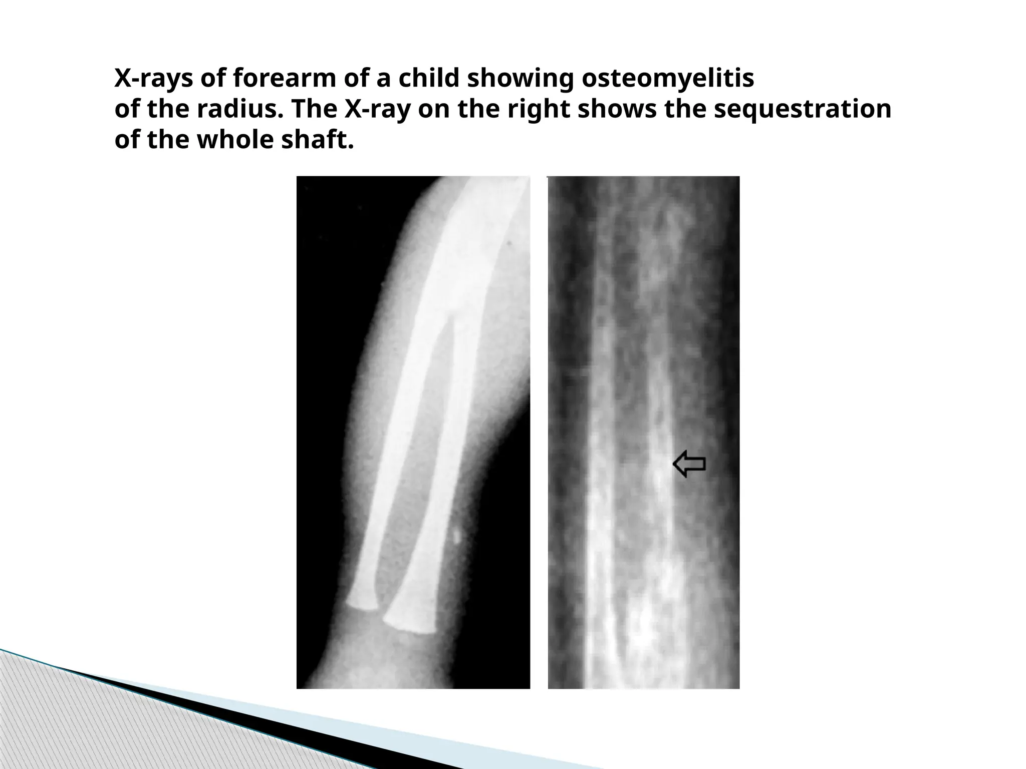 OSTEOMYELITIS.pptx. ..... | PPTX