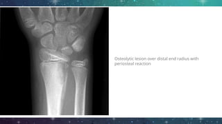 Osteolytic lesion over distal end radius with
periosteal reaction
 