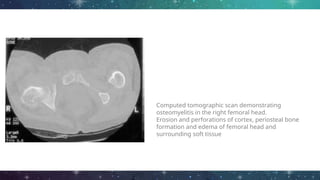 Computed tomographic scan demonstrating
osteomyelitis in the right femoral head.
Erosion and perforations of cortex, periosteal bone
formation and edema of femoral head and
surrounding soft tissue
 