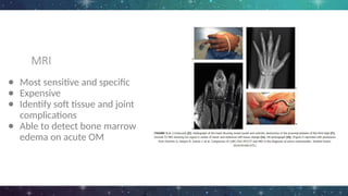 MRI
● Most sensitive and specific
● Expensive
● Identify soft tissue and joint
complications
● Able to detect bone marrow
edema on acute OM
 