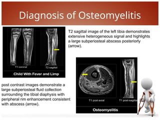 Comprehensive Overview of Pediatric Osteomyelitis: Diagnosis ...