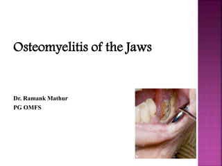 Osteomyelitis of the Jaws
Dr. Ramank Mathur
PG OMFS
 