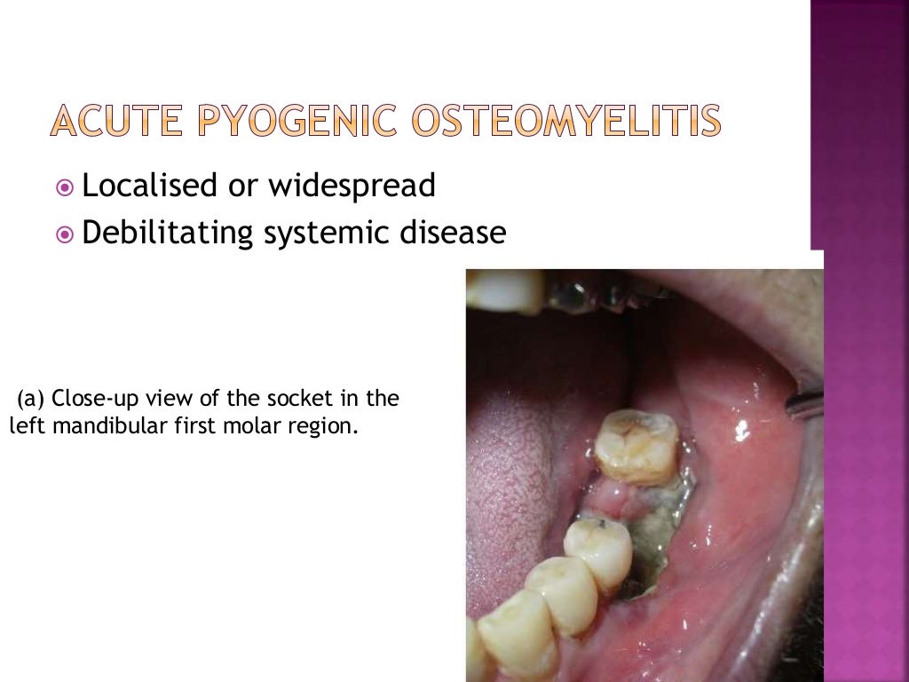 Osteomyelitis of jaws