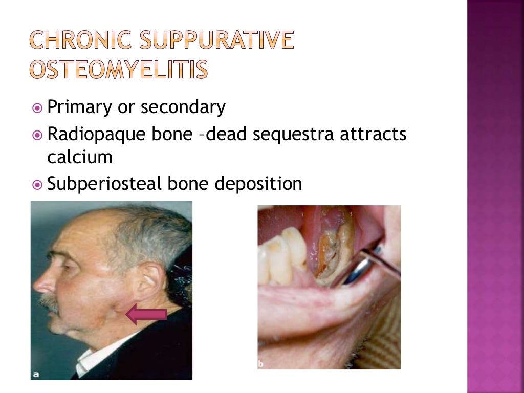 Osteomyelitis of jaws