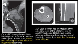 osteomyelitis and infections arthritis ,soft tissue .pptx