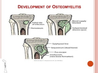 DEVELOPMENT OF OSTEOMYELITIS
 