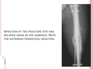 INFECTION AT THE FRACTURE SITE HAS
DELAYED UNION IN THE HUMERUS. NOTE
THE EXTENSIVE PERIOSTEAL REACTION.
 
