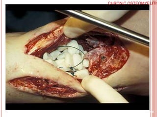 44
CHRONIC OSTEOMYELITIS
 