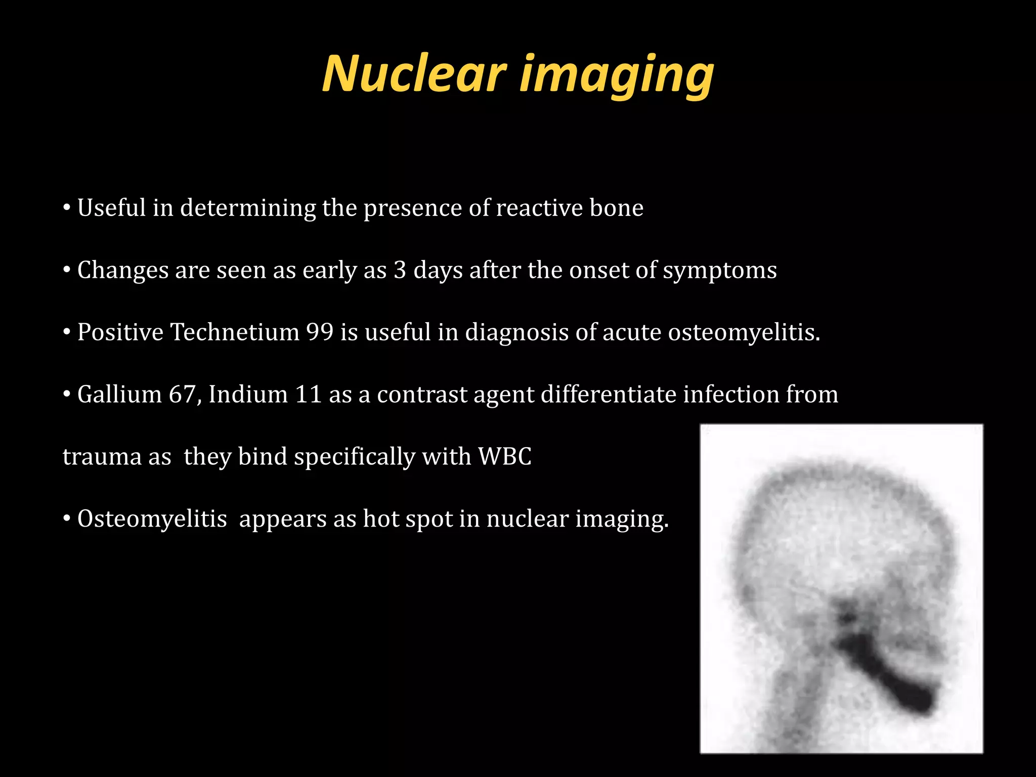 Positive Indium Scan Osteomyelitis in maxillofacial region | PDF