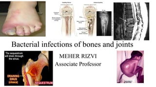 Bacterial infections of bones and joints
MEHER RIZVI
Associate Professor
 