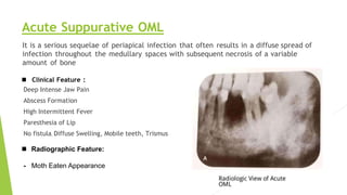 Acute Suppurative OML
It is a serious sequelae of periapical infection that often results in a diffuse spread of
infection throughout the medullary spaces with subsequent necrosis of a variable
amount of bone
 Clinical Feature :
Deep Intense Jaw Pain
Abscess Formation
High Intermittent Fever
Paresthesia of Lip
No fistula, Diffuse Swelling, Mobile teeth, Trismus
 Radiographic Feature:
- Moth Eaten Appearance
 