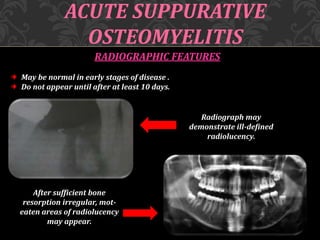 ACUTE SUPPURATIVE
OSTEOMYELITIS
RADIOGRAPHIC FEATURES
May be normal in early stages of disease .
Do not appear until after at least 10 days.
After sufficient bone
resorption irregular, mot-
eaten areas of radiolucency
may appear.
Radiograph may
demonstrate ill-defined
radiolucency.
 