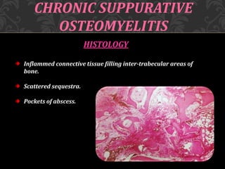 CHRONIC SUPPURATIVE
OSTEOMYELITIS
HISTOLOGY
Inflammed connective tissue filling inter-trabecular areas of
bone.
Scattered sequestra.
Pockets of abscess.
 