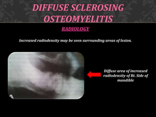 RADIOLOGY
Increased radiodensity may be seen surrounding areas of lesion.
DIFFUSE SCLEROSING
OSTEOMYELITIS
Diffuse area of increased
radiodensity of Rt. Side of
mandible
 
