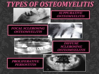 TYPES OF OSTEOMYELITIS
SUPPURATIVE
OSTEOMYELITIS
FOCAL SCLEROSING
OSTEOMYELITIS
DIFFUSE
SCLEROSING
OSTEOMYELITIS
PROLIFERATIVE
PERIOSTITIS
 