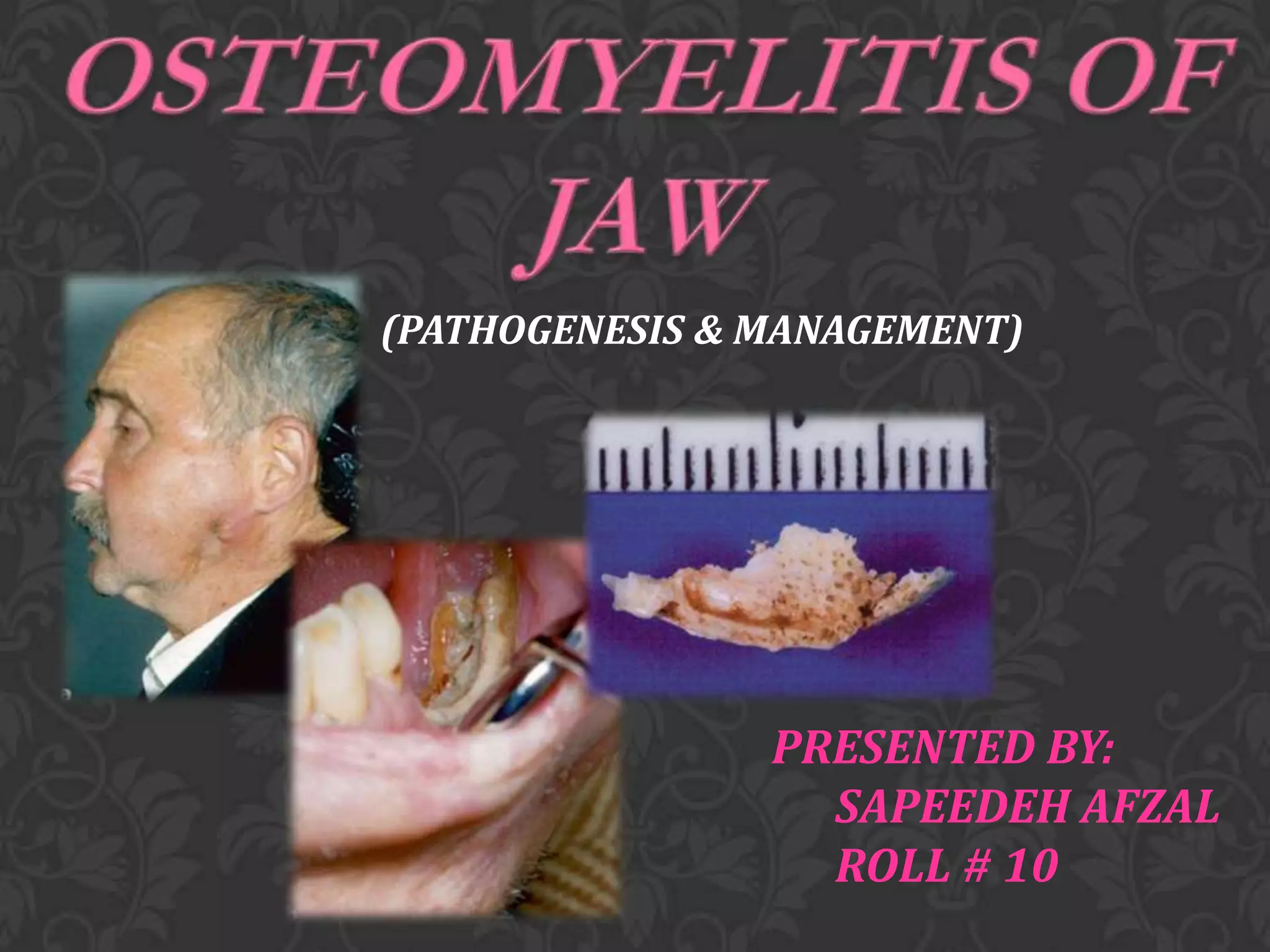 Osteomyelitis of jaw PPT