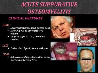 ACUTE SUPPURATIVE
OSTEOMYELITIS
CLINICAL FEATURES
EARLY :
 Severe throbbing, deep- seated pain.
 Swelling due to inflammatory
edema.
 Gingiva appears red, swollen &
tender.
LATE :
 Distension of periosteum with pus.
FINAL:
 Subperiosteal bone formation cause
swelling to become firm.

 