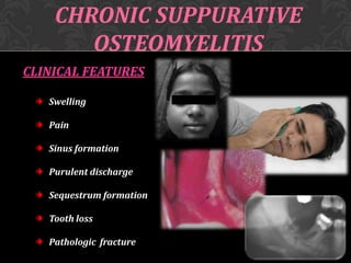 CHRONIC SUPPURATIVE
OSTEOMYELITIS
CLINICAL FEATURES
Swelling
Pain
Sinus formation
Purulent discharge
Sequestrum formation
Tooth loss
Pathologic fracture

 