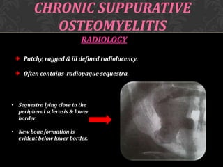 CHRONIC SUPPURATIVE
OSTEOMYELITIS
RADIOLOGY
Patchy, ragged & ill defined radiolucency.
Often contains radiopaque sequestra.

• Sequestra lying close to the
peripheral sclerosis & lower
border.

• New bone formation is
evident below lower border.

 
