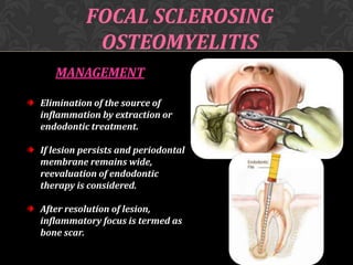 FOCAL SCLEROSING
OSTEOMYELITIS
MANAGEMENT
Elimination of the source of
inflammation by extraction or
endodontic treatment.

If lesion persists and periodontal
membrane remains wide,
reevaluation of endodontic
therapy is considered.
After resolution of lesion,
inflammatory focus is termed as
bone scar.

 
